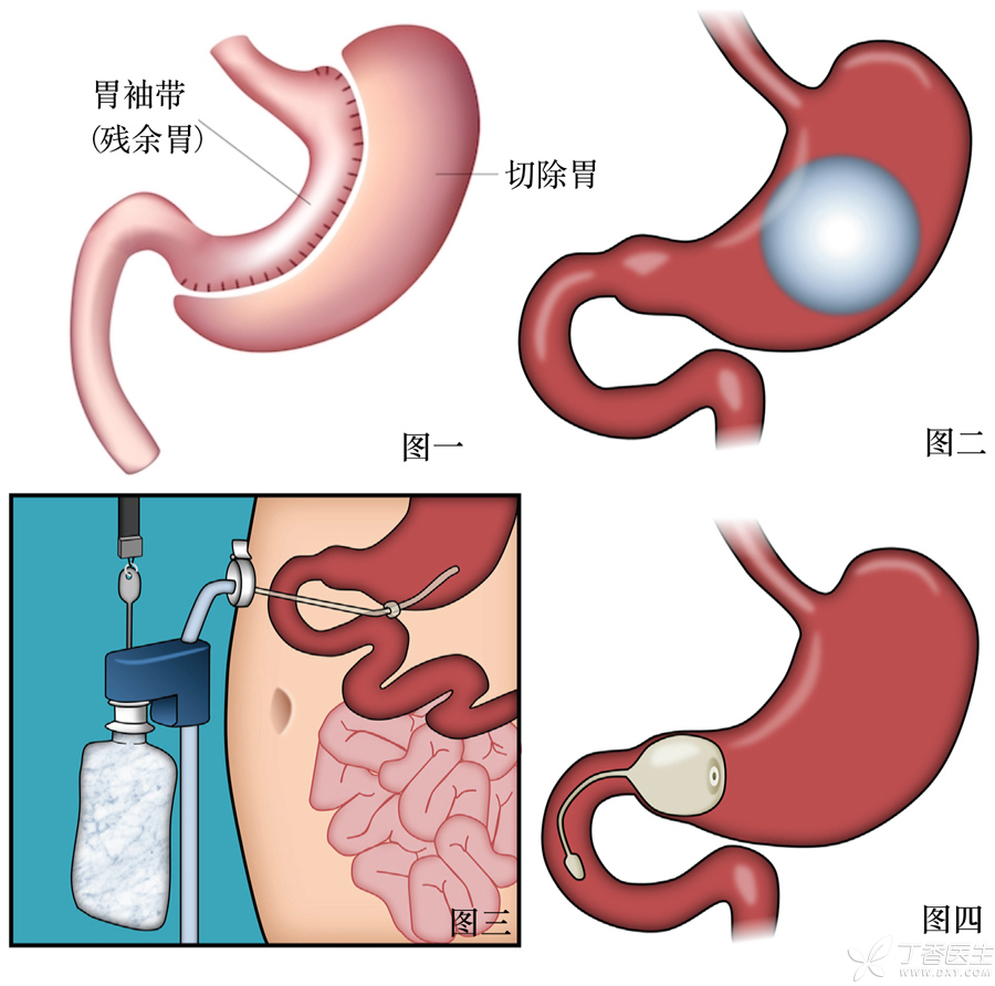 减重手术中最常见,也是首选的方式是腹腔镜下袖状胃切除术.