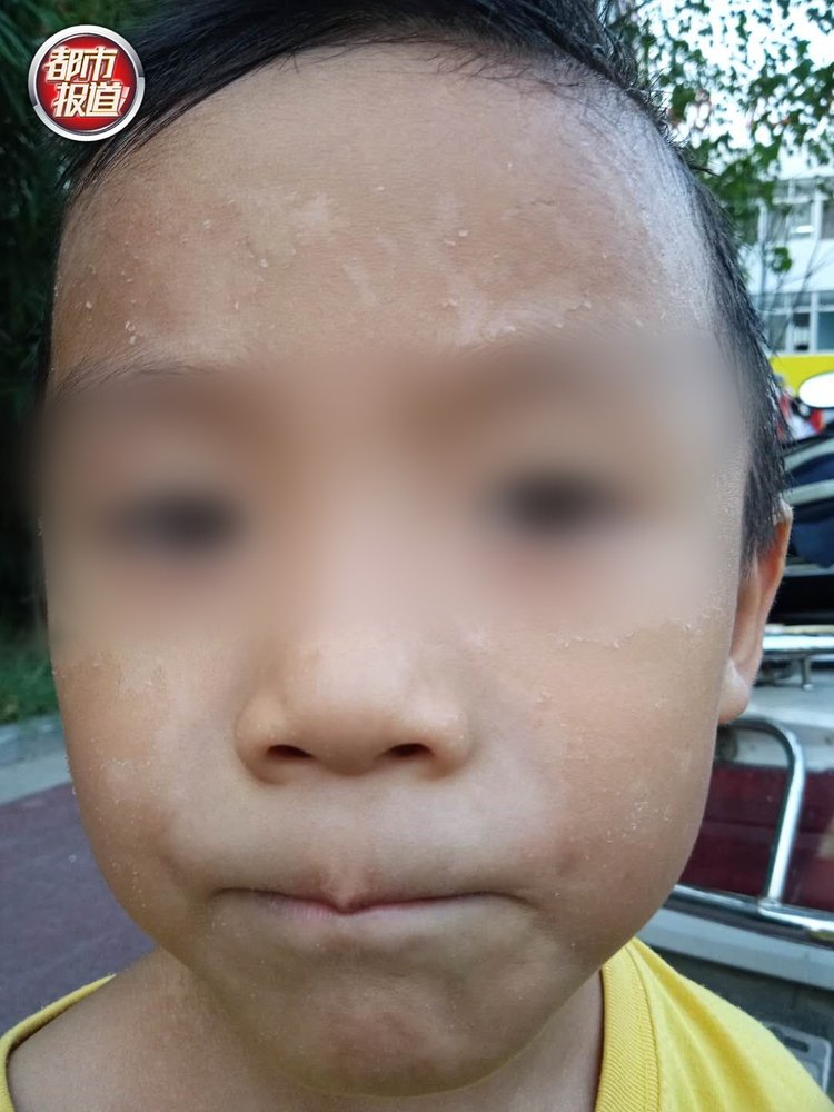误开紫外线灯,多名幼儿被灼伤!涉事幼儿园曾被停办