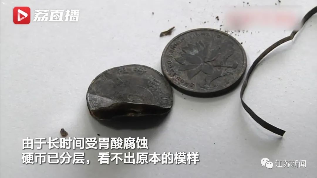 新乡11岁男孩春节吃饺子吞下2枚硬币，1年后才取出！网友沸腾了