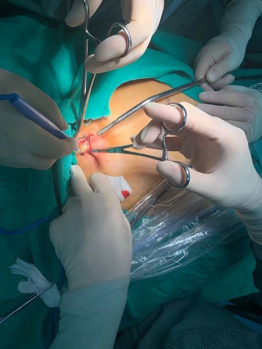 气胸胸腔镜手术过程图片