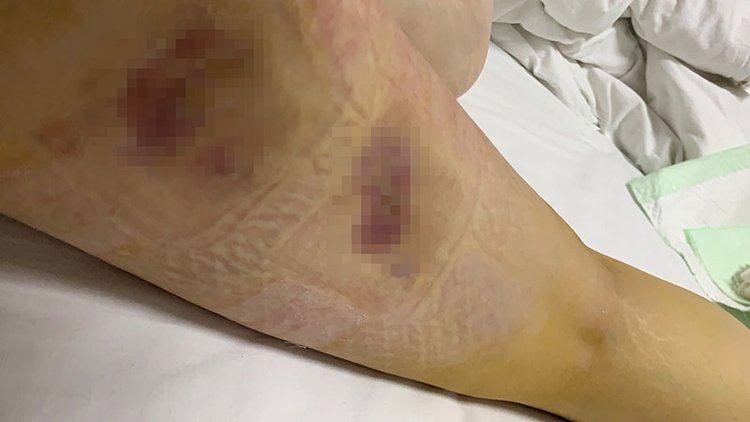 漯河女子花2万元美腿失败 手术治疗四个多月“一走路就疼”