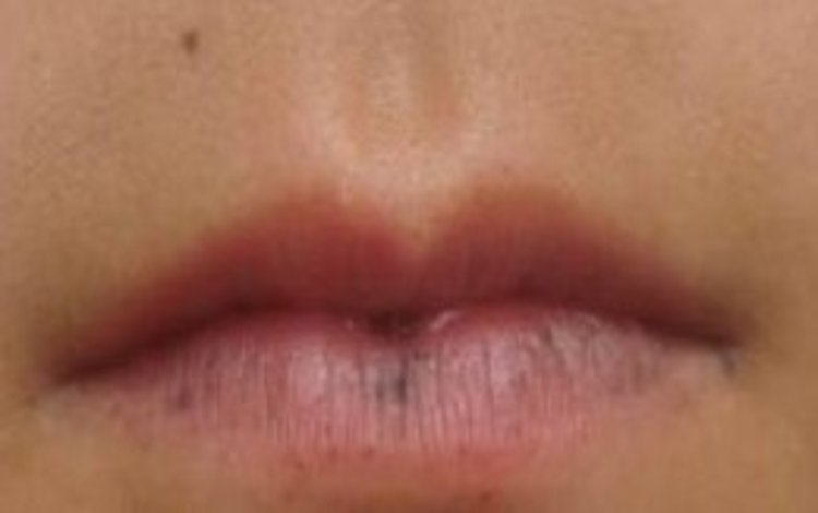 小伙儿手足口上长黑斑胃里肠里长息肉是啥病